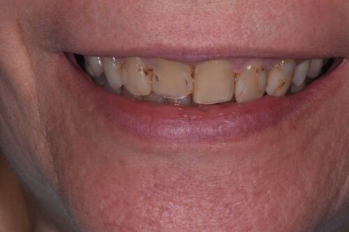 before dental services from Monokian Dentistry