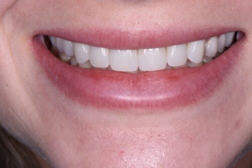 after dental services from Monokian Dentistry