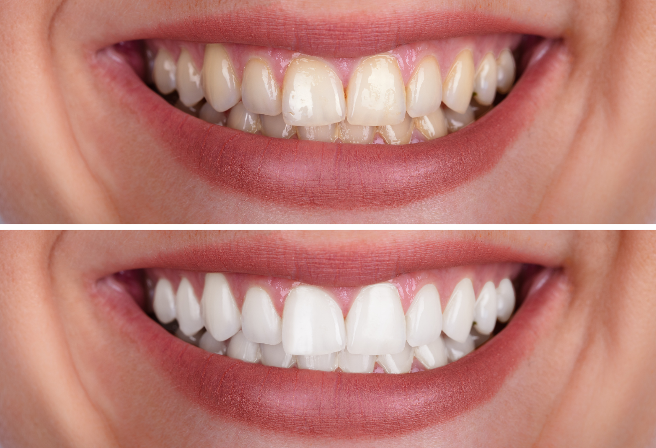 Teeth Whitening in Marlton, NJ