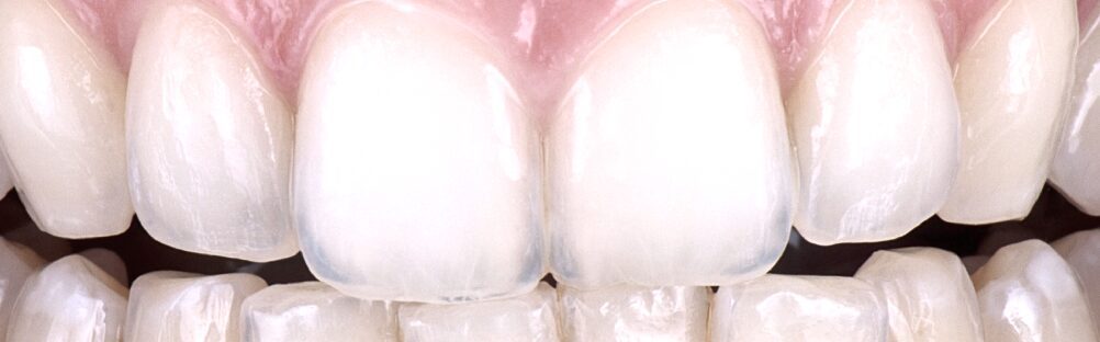 Teeth After Icon Treatment